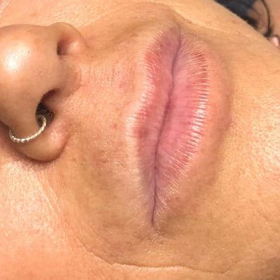 Before Lip Enhancement