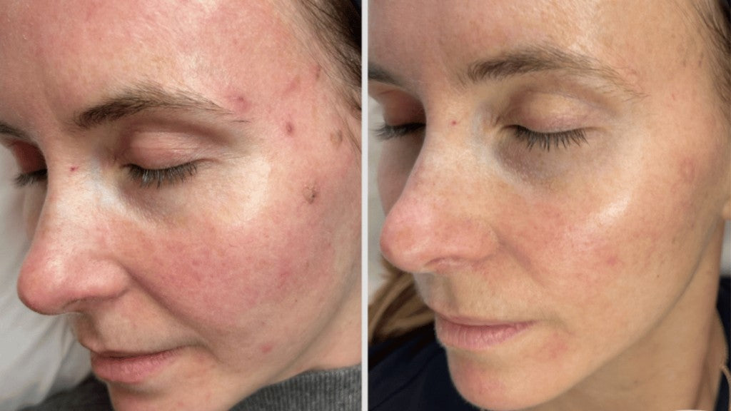Salmon DNA & PDRN Therapy Boonton NJ | Alora Med Spa