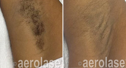 Underarm