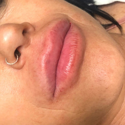 After Lip Enhancement